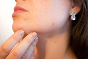 Avis sur le CBD anti-acné : toutes nos recommandations !